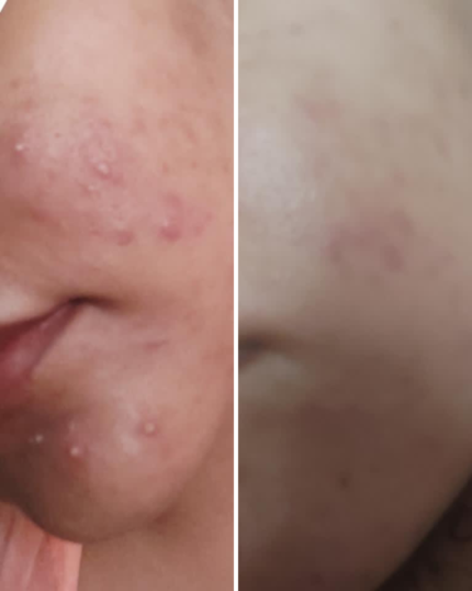 vitamincbeforeafter 1